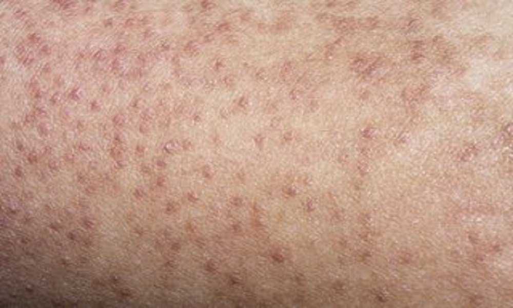 How to Treat your Child's Keratosis Pilaris or “Chicken Skin” Naturally -  Mummy and Child
